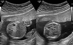 Congenital pulmonary airway malformation in a fetus, ultrasound at 19 weeks - transverse. Stomach on left image; heart on right image: displaced to right by cystic mass