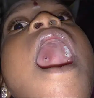 Perforation of palate