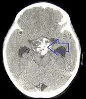 CT scan showing a craniopharyngioma
