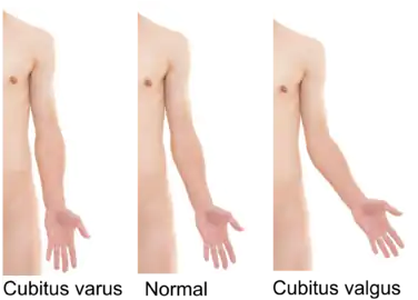 Cubitus varus and cubitus valgus.