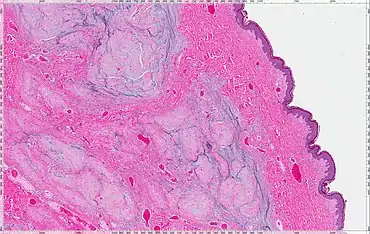 Cutaneous Myxoma