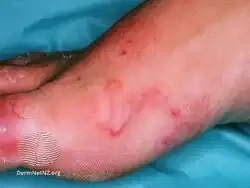 Cutaneous larva migrans