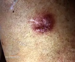 Cutaneous tuberculosis