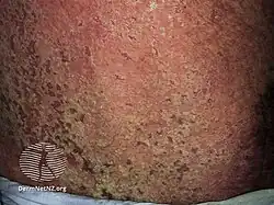 Rash associated with Darier's disease