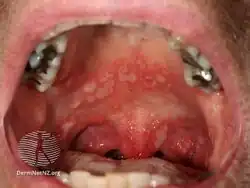 An example of herpangina