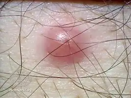 Dermoscopy view Reticulohistiocytoma