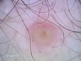 Dermoscopy view Reticulohistiocytoma