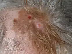 Desmoplastic melanoma