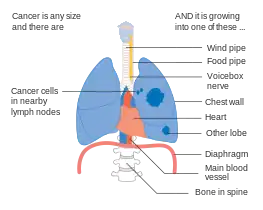 Stage IIIA lung cancer