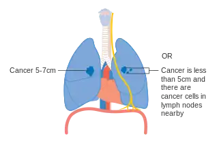 Stage IIA lung cancer