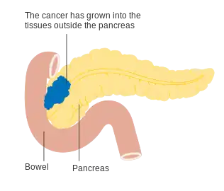 Stage T3 pancreatic cancer