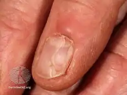 Digital myxoid cyst