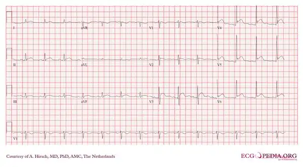Severe hypercalcemia: calcium 4.6 mmol/L, albumin 37 g/L