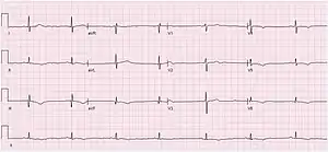 An ECG showing sinus bradycardia at 43 bpm. The image is made up of a red grid on a white background. A black line traces the patients heart beat.