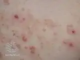Crusted eczema