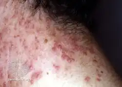 Elastosis perforans serpiginosa