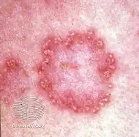 Elastosis perforans serpiginosa