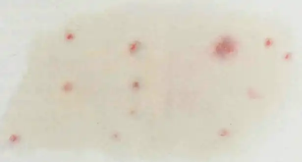 Petechial rash