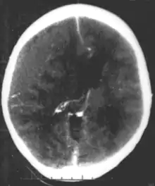 Nontraumatic epidural hematoma in a young woman. The grey area in the top left is organizing hematoma, causing midline shift and compression of the ventricle.