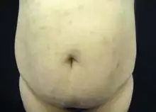 Erythema dyschromicum perstans