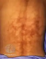 Erythema ab igne