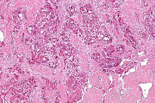 Intermed. mag.Fibrolamellar hepatocellular carcinoma