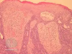 Aggressive digital papillary adenocarcinoma-pathology
