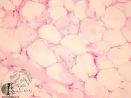 Sclerema neonatorum/pathology
