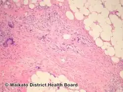 Necrobiotic xanthogranuloma-pathology