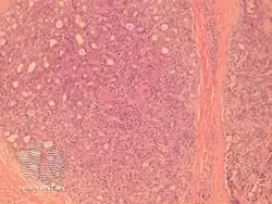 Aggressive digital papillary adenocarcinoma-pathology