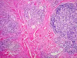 IgG4-related skin disease pathology
