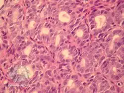 Aggressive digital papillary adenocarcinoma-pathology