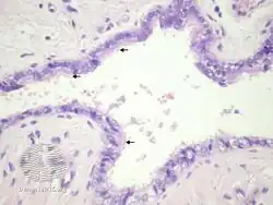 pathology-Cutaneous ciliated cyst