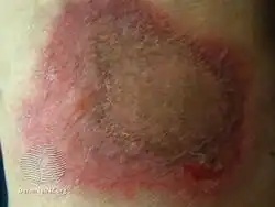 Fixed drug reaction (targeted)