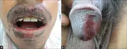 Fixed drug reaction (lips and penis)