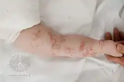 Focal dermal hypoplasia