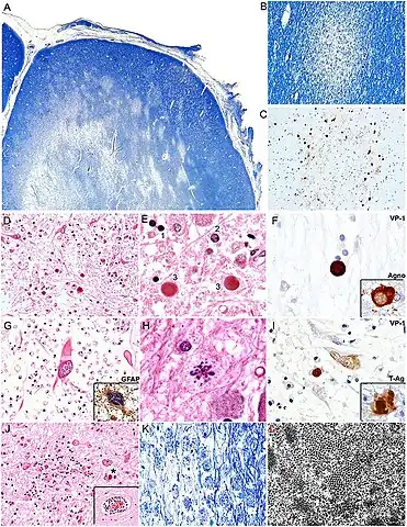 a-l)Histopathological features of PML