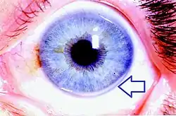 Four examples of cholesterol deposits at the outer edge of the cornea.