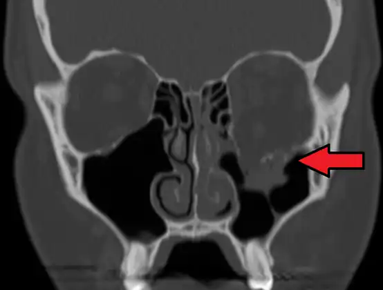 Orbital blowout fracture demonstrating enophthalmos