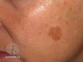 Freckle before cryotherapy