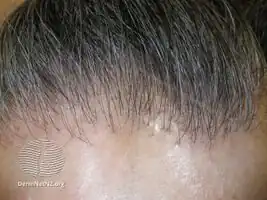 Frontal fibrosing alopecia