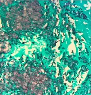 Gomori methenamine silver stain highlights numerous budding yeast and occasional pseudohyphal forms in  mitral valve corresponding to C. lusitaniae recovered from culture
