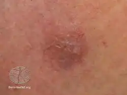 Granuloma faciale