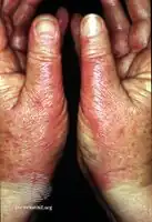 Hands burning after PUVA soaks