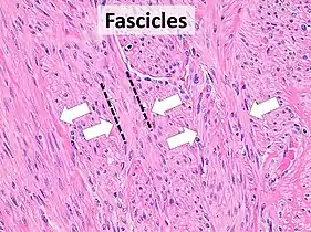 Fascicular: Generally the same cell type throughout, but some form band-like groups that are aligned in the same direction.
