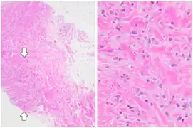 ILC may be subtle on low magnification (left). Higher magnification (right) shows invasive growth pattern and vesicular nuclei with prominent nucleoli.