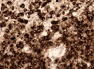 IDH1 R132H in anaplastic oligodendroglioma