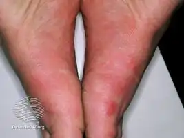 Idiopathic plantar hidradenitis