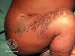 Incontinentia pigmenti