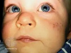 Infantile acne